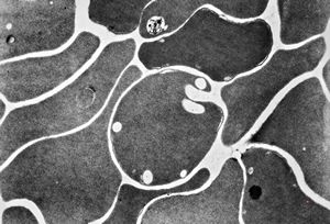M,30y. | blood - dyserythropoetic anemia M,30y. | blood - dyserythropoetic anemia